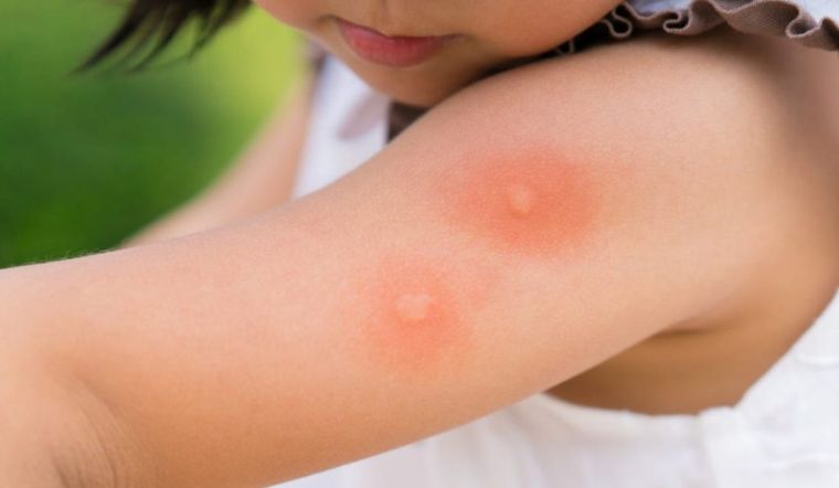 Ba, mẹ đừng chủ quan những vết thương do muỗi và côn trùng đốt ở trẻ