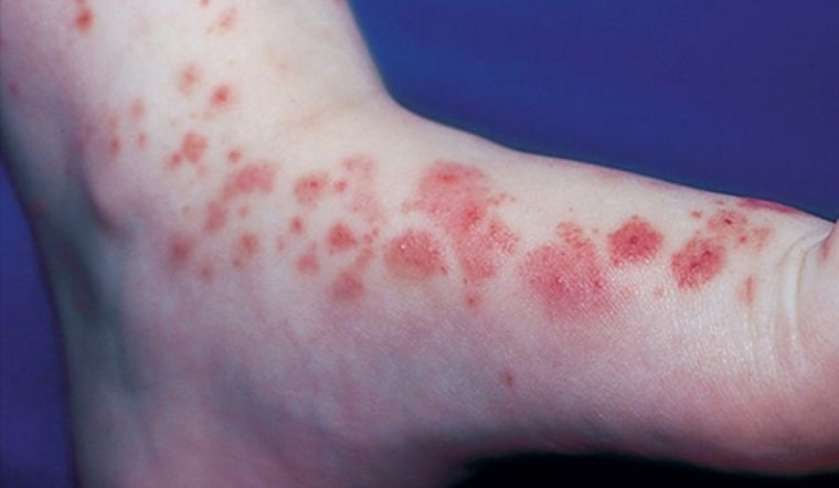 Bệnh viêm mạch do IgA là gì? Có nguy hiểm với trẻ không?
