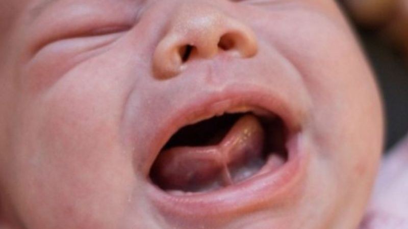 Bé bị tật dính thắng lưỡi