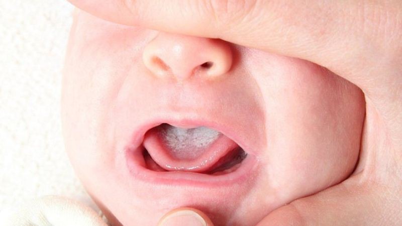 Bé bị nấm miệng