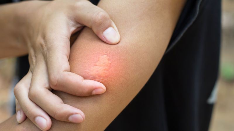 Làm dịu vết ong đốt