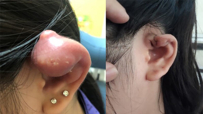 Tai bị nổi hạch, sưng đau ngứa