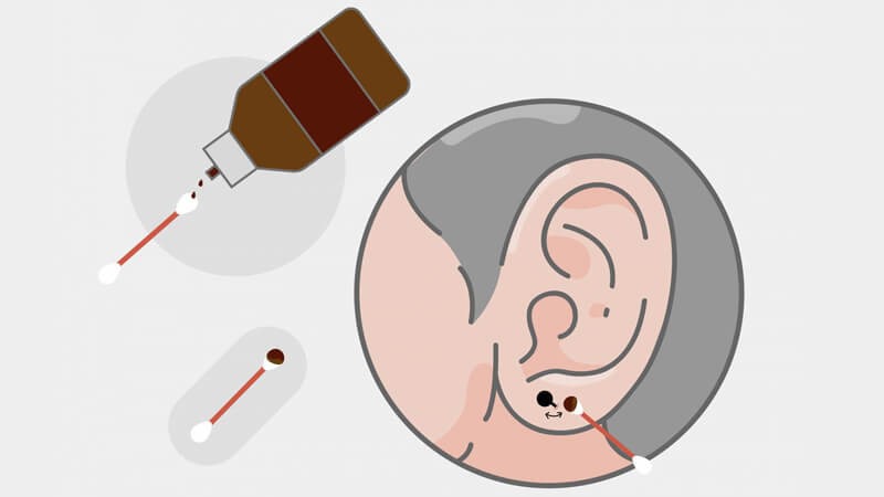 Dùng cồn đỏ lau sạch mặt trước và sau lỗ xỏ