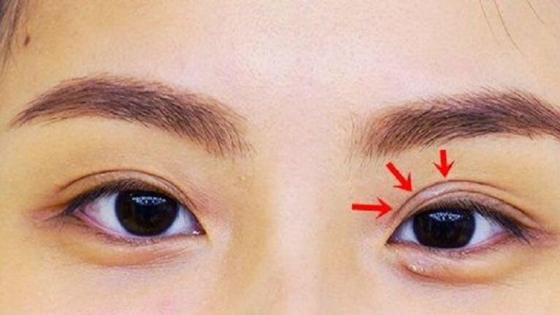 Nguyên nhân dẫn đến mắt mí lót
