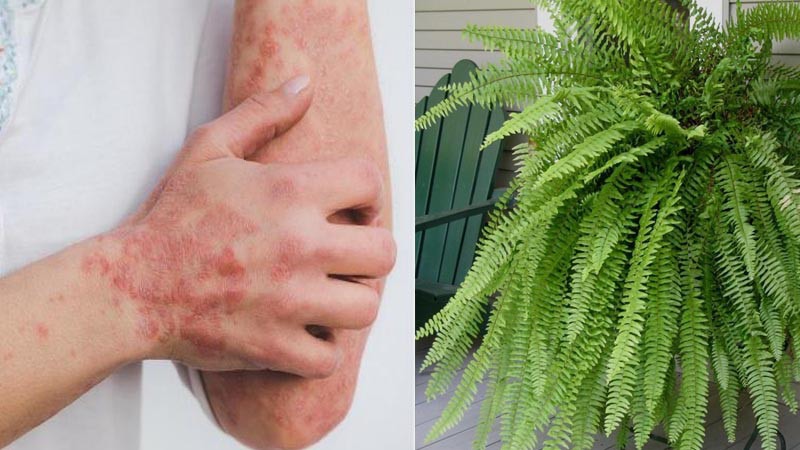 Dương xỉ điều trị vảy nến