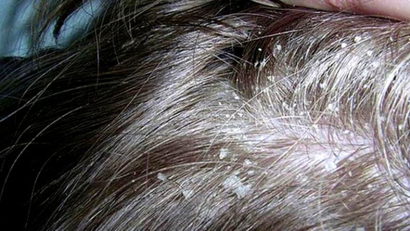 Công dụng trị nấm và gàu của giấm