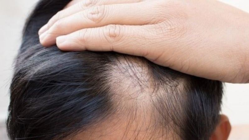 Nguyên nhân khiến tóc nam giới bị khô xơ