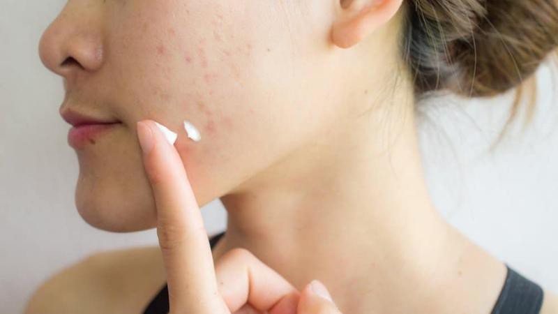 Cách dùng chấm mụn Epiduo đúng và an toàn