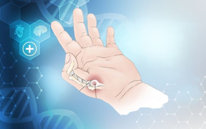 Chẩn đoán bệnh ngón tay cò súng ở trẻ em