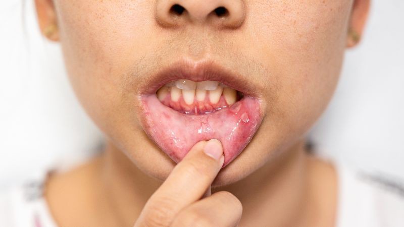 Loét canker ở miệng là bệnh gì?